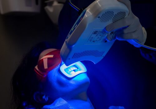 Sbiancamento dentale